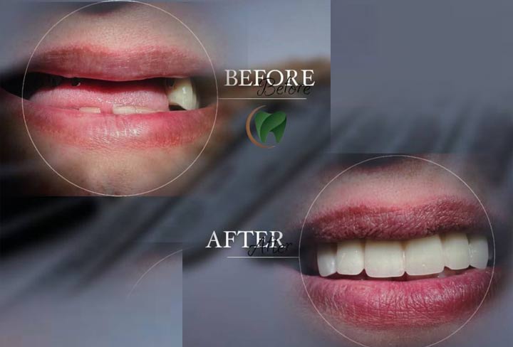 Dental Implant Cost in Iran