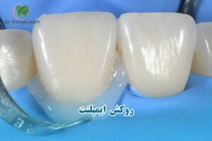 چسب روکش ایمپلنت