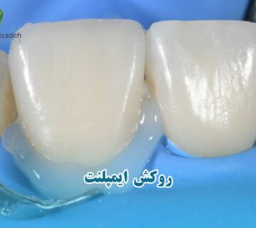 چسب روکش ایمپلنت