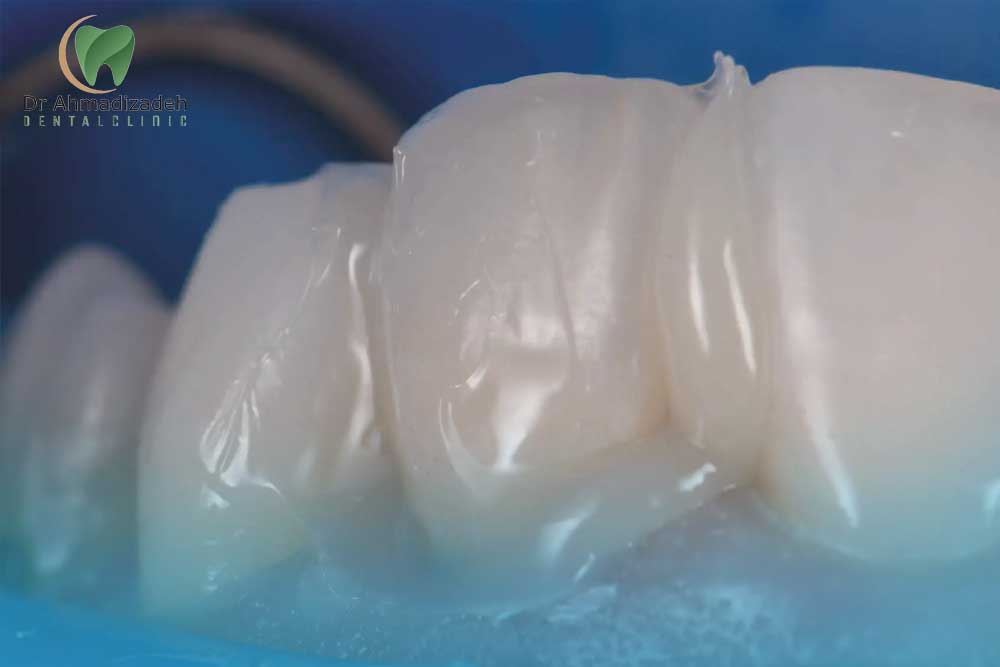 چسب روکش ایمپلنت