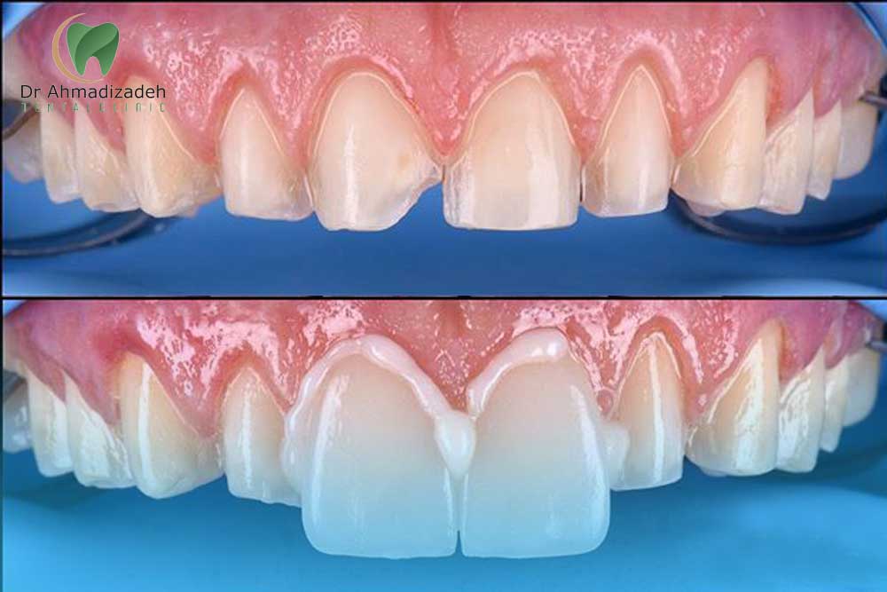 چسب روکش ایمپلنت