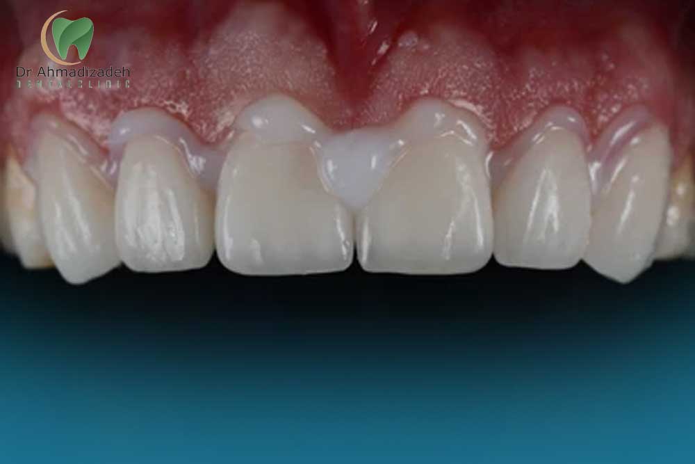 چسب روکش ایمپلنت