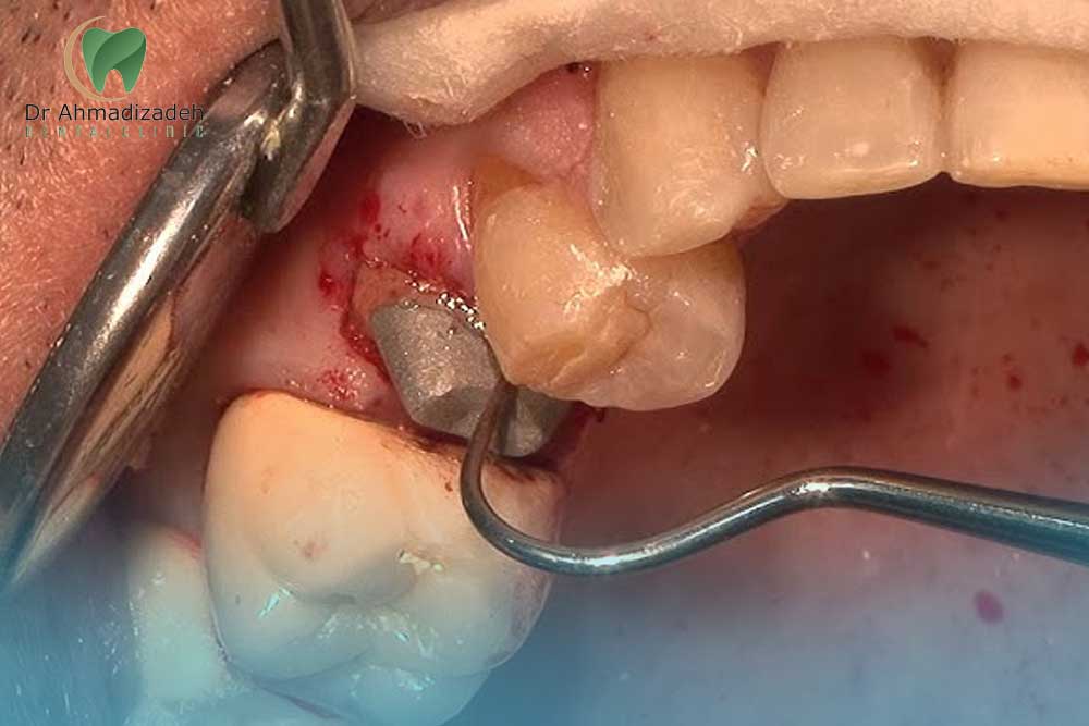 چسب روکش ایمپلنت