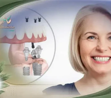 بهترین سن ایمپلنت چند سال است؟