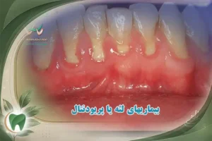 بیماری های لثه و پریودنتال