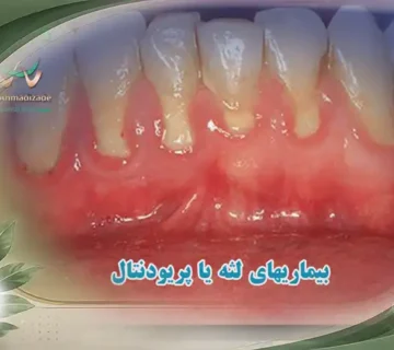 بیماری های لثه و پریودنتال