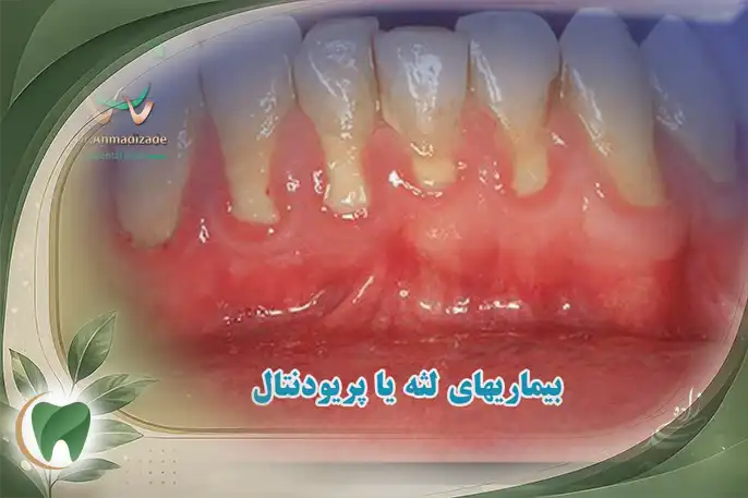 بیماری های لثه و پریودنتال