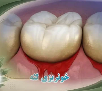 خونریزی لثه راه های درمان و پیشگیری