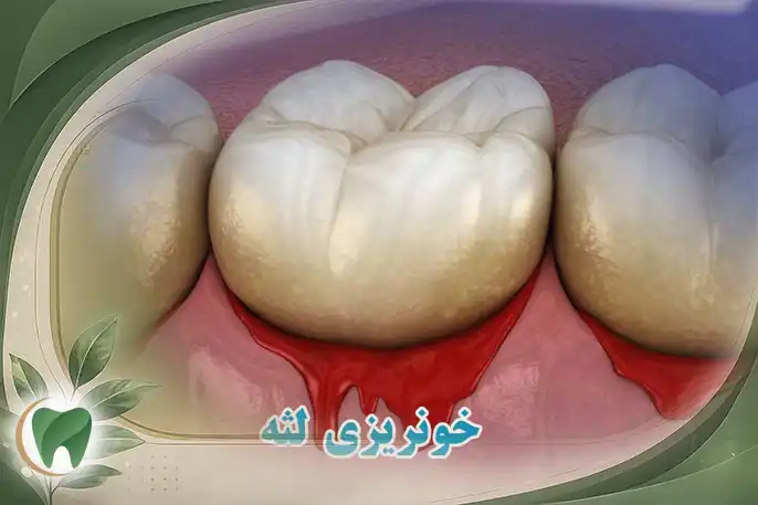 خونریزی لثه راه های درمان و پیشگیری
