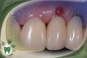 عوارض ایمپلنت دندان برای افراد