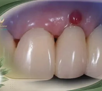 عوارض ایمپلنت دندان برای افراد