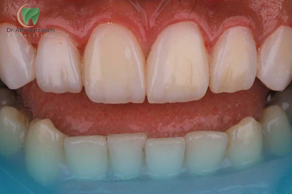 لمینت در قیطریه
