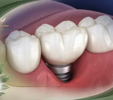 موفقیت کاشت ایمپلنت دندان چند درصد است؟