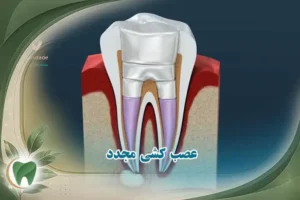 عصب کشی مجدد
