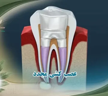 عصب کشی مجدد