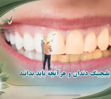 هزینه بلیچینگ دندان