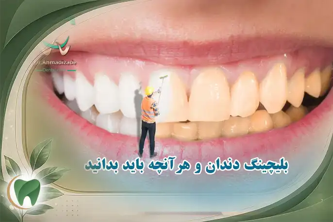 هزینه بلیچینگ دندان