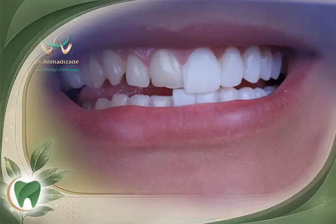 کامپوزیت دندان مزایا و معایب