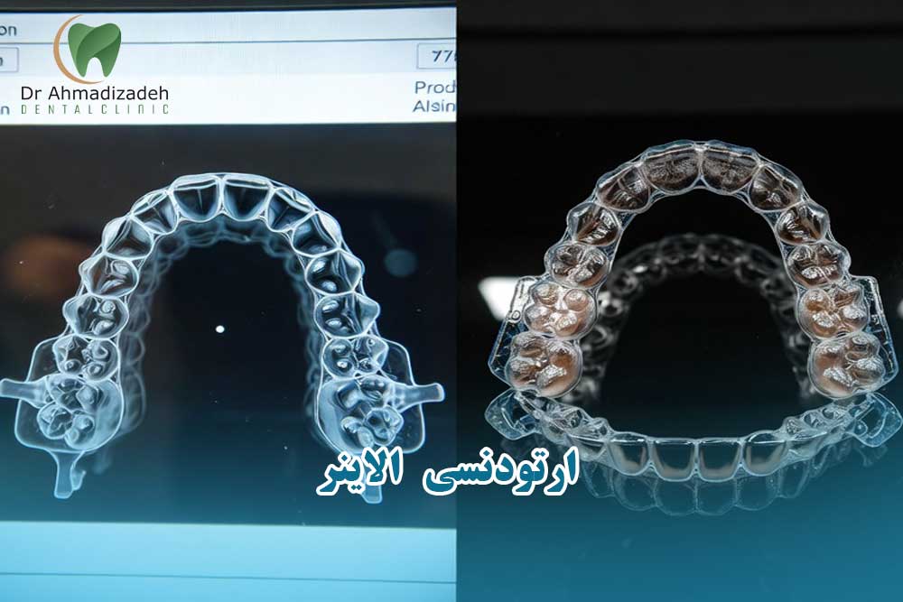 ارتودنسی الاینر