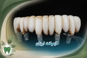 ایمپلنت ارزان اقتصادی