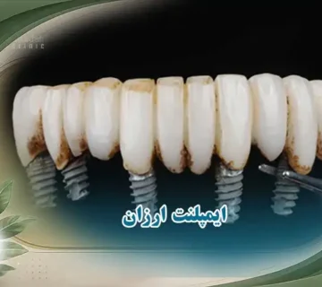 ایمپلنت ارزان اقتصادی