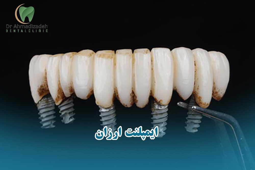 ایمپلنت ارزان و اقتصادی