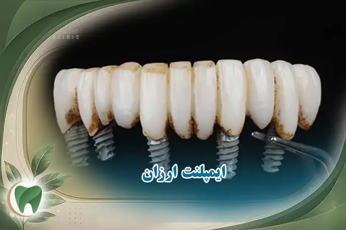 ایمپلنت ارزان اقتصادی