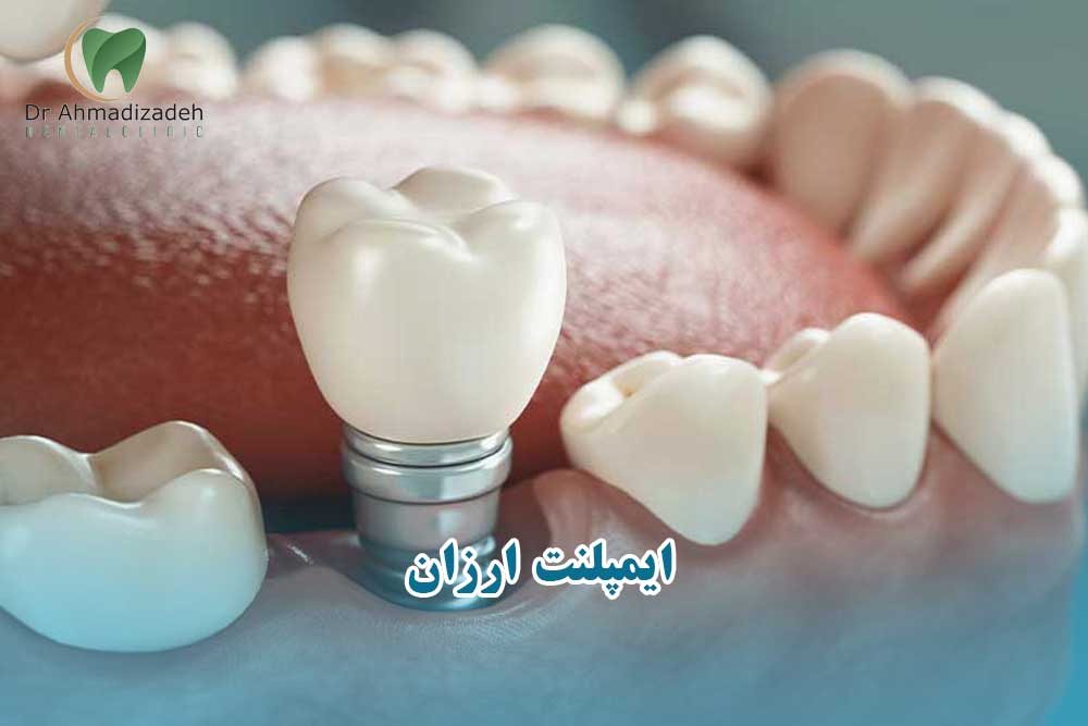 ایمپلنت ارزان و اقتصادی
