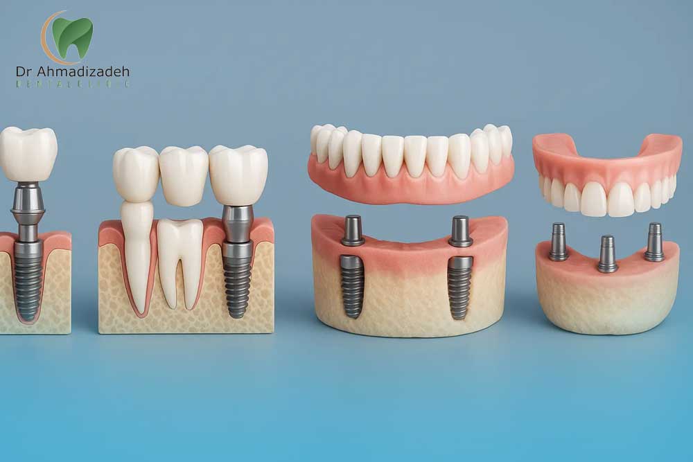 ایمپلنت ارزان و اقتصادی