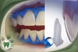 بلیچینگ یا لمینت