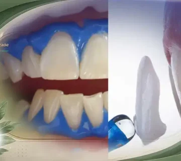 بلیچینگ یا لمینت