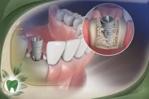 حساسیت بدن به ایمپلنت