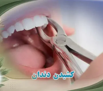 کشیدن دندان