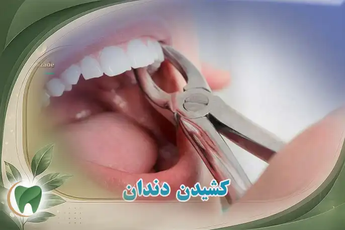 کشیدن دندان
