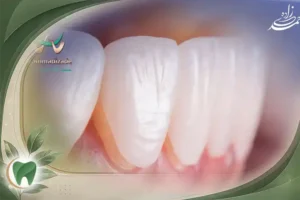 لمینت دندان در قیطریه تهران