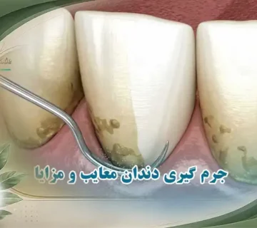 جرم گیری دندان را خراب میکند؟