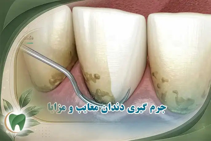 جرم گیری دندان را خراب میکند؟