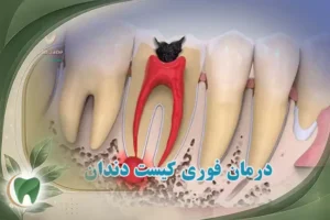 درمان فوری کیست دندان در خانه