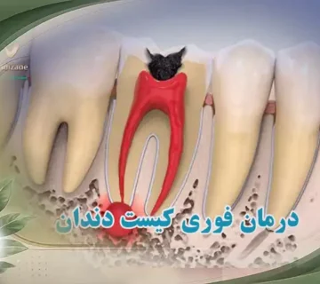 درمان فوری کیست دندان در خانه
