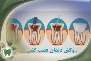 روکش دندان عصب کشی شده