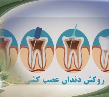 روکش دندان عصب کشی شده