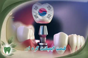 قیمت ایمپلنت کره ای در تهران