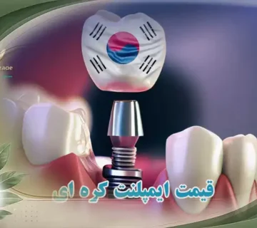 قیمت ایمپلنت کره ای در تهران