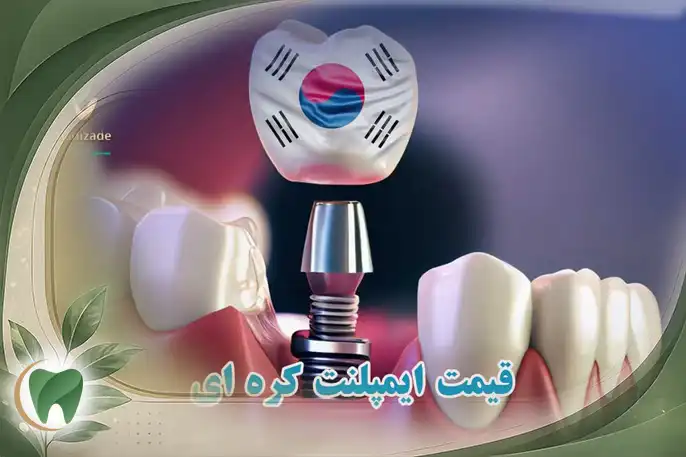 قیمت ایمپلنت کره ای در تهران