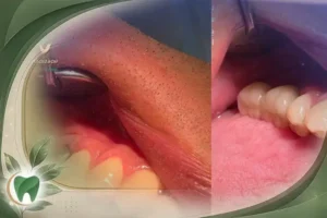 مزایای ایمپلنت