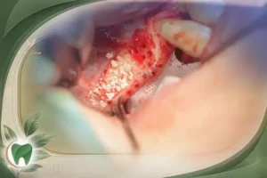 پیوند استخوان برای ایمپلنت دندان