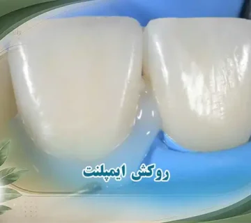 چسب روکش ایمپلنت چیست؟