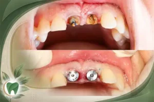 پیش‌پرداخت ایمپلنت چقدر است ؟