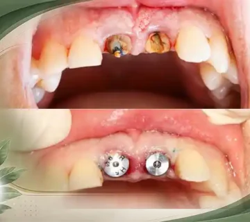 پیش‌پرداخت ایمپلنت چقدر است ؟