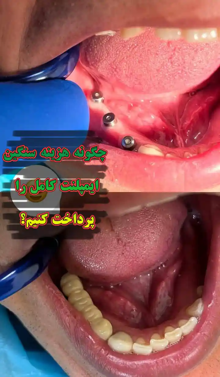 هزینه ایمپلنت کل دهان